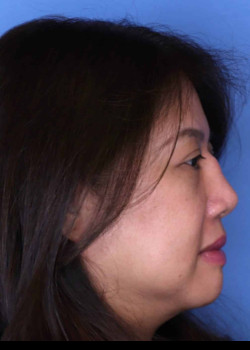 Revision Rhinoplasty